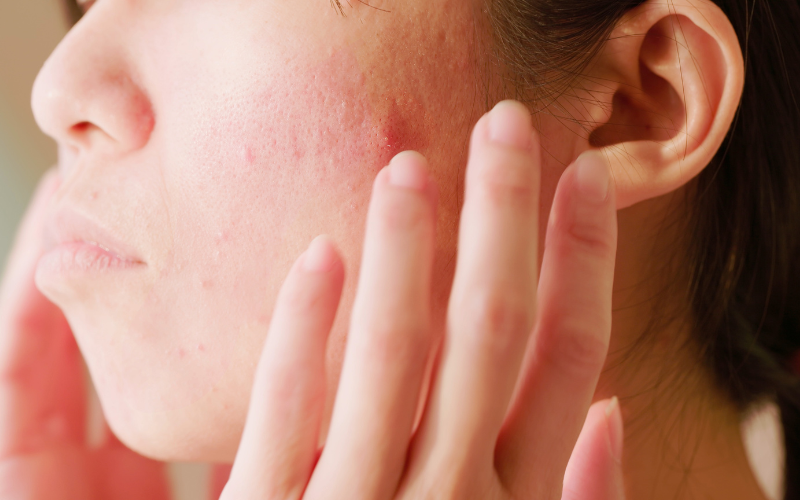 Bạn có đang bị dị ứng mỹ phẩm?