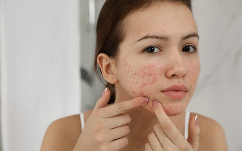 Dị ứng mỹ phẩm và cách “cấp cứu” da dị ứng hiệu quả nhất  